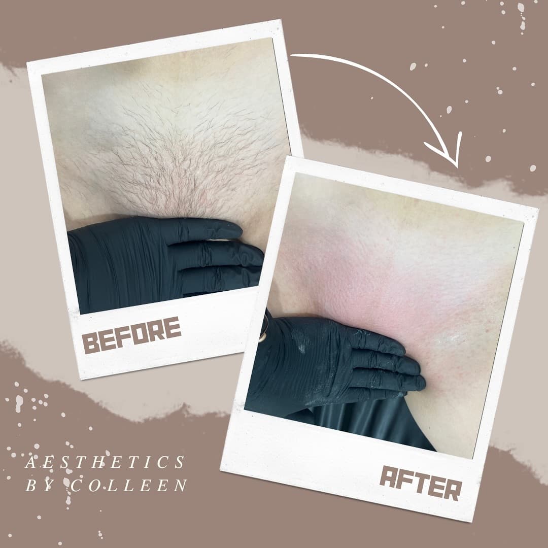 Brazilian & Bikini Waxing gallery 4