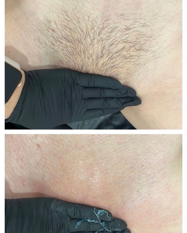 Brazilian & Bikini Waxing gallery 6