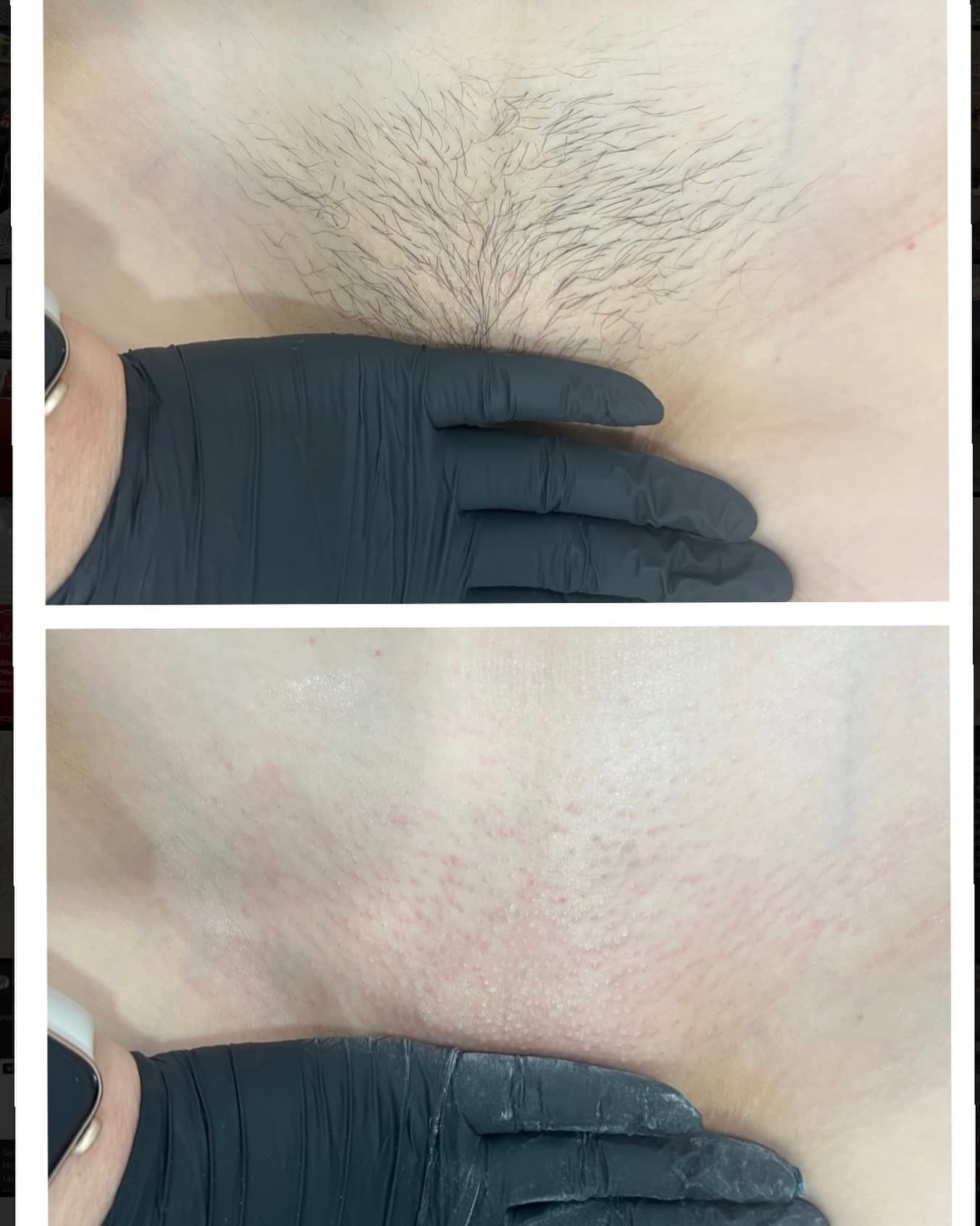 Brazilian & Bikini Waxing gallery 7