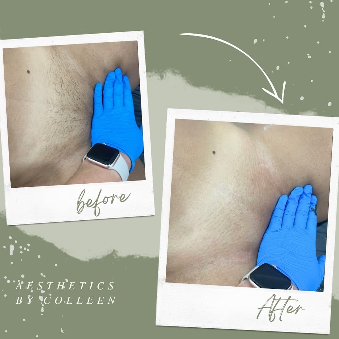 Brazilian & Bikini Waxing gallery 11